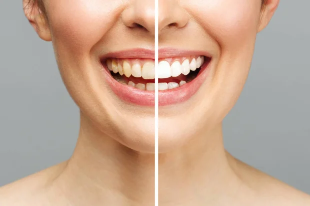 5 fantastic reasons to choose Zoom teeth whitening