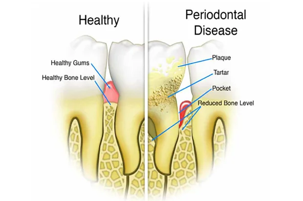 how tooth decay develops