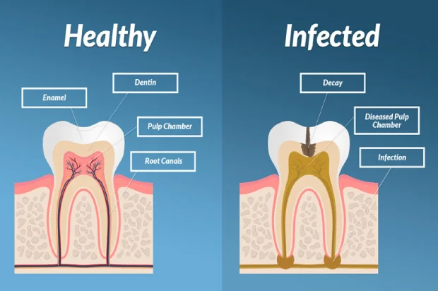 root canals