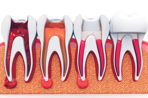 trust kings langley dental for your root canal needs