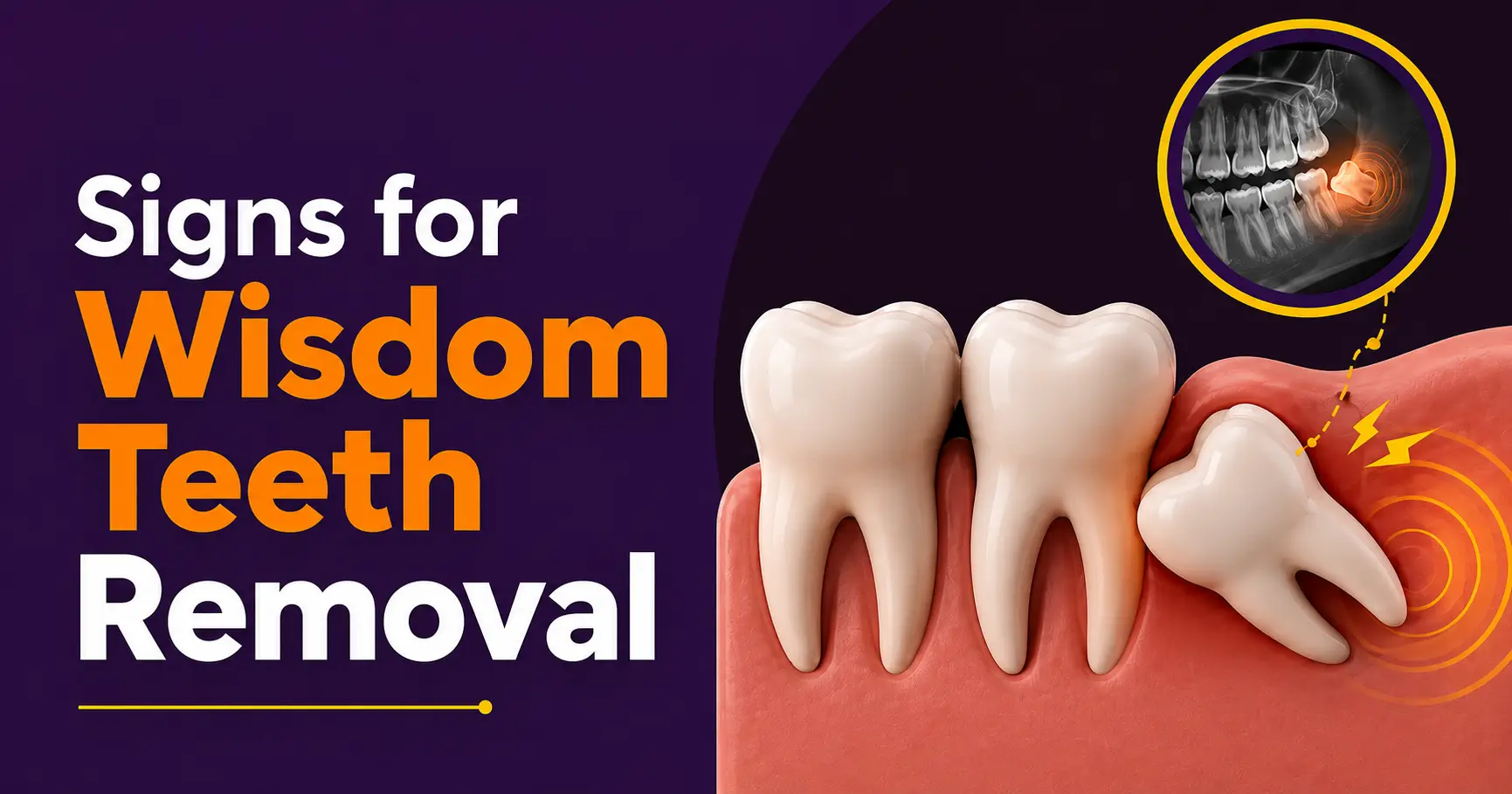 Signs You May Need Wisdom Teeth Removal