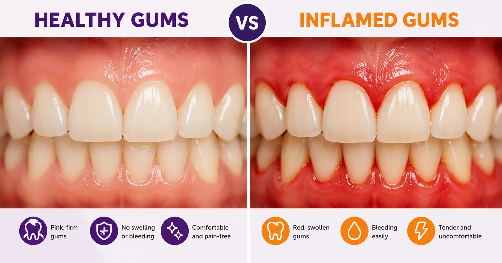 How gum disease progresses gingivitis to periodontitis