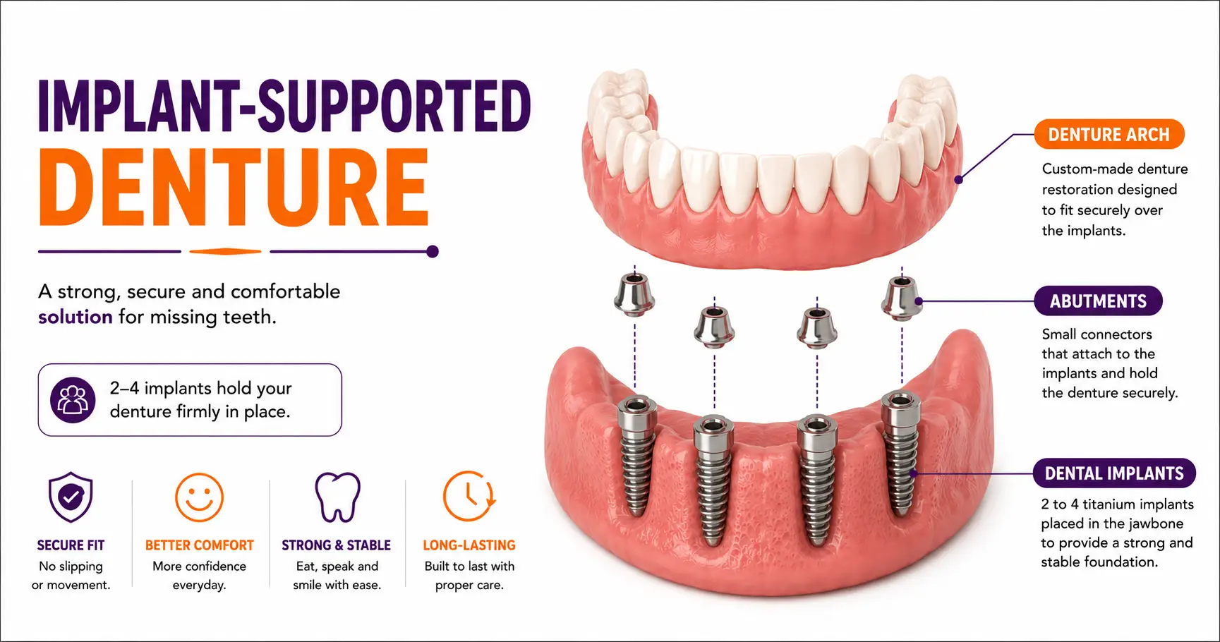 Implant-supported denture diagram