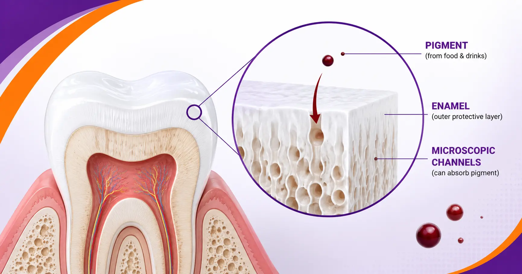 Illustration showing how pigments can penetrate freshly whitened enamel during the 48-hour window.