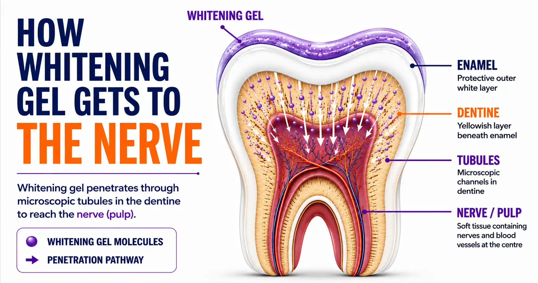 Why Do My Teeth Hurt After Whitening?