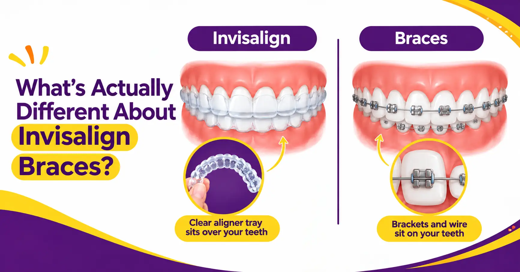 How Invisalign and braces work on teeth