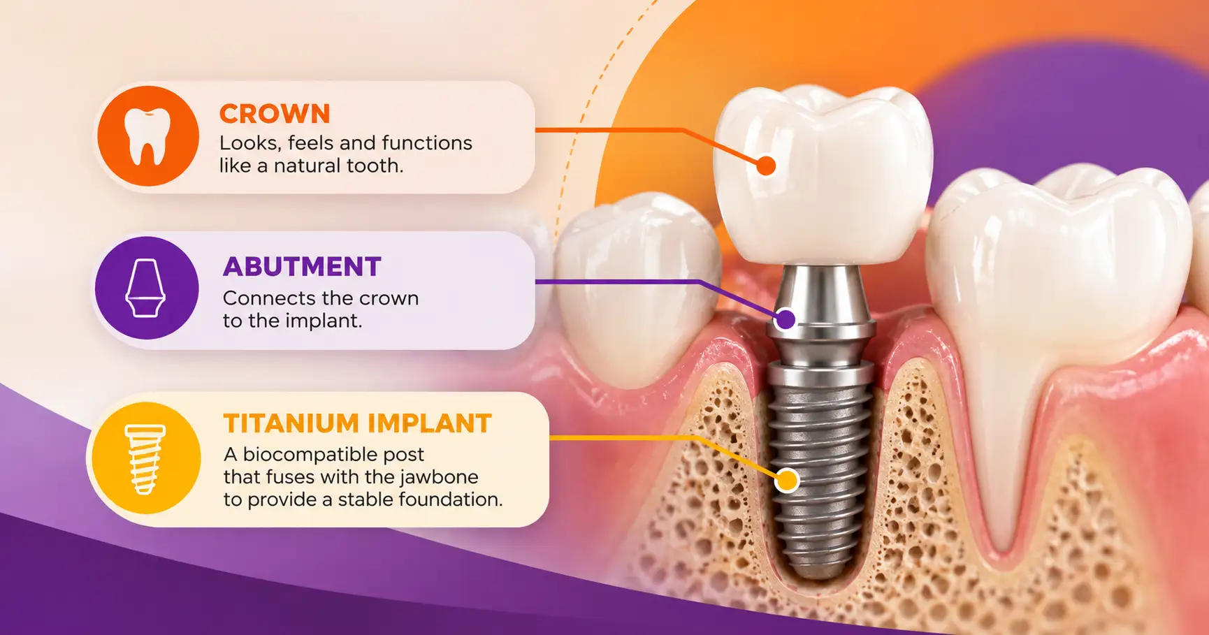 Diagram of a dental implant showing the titanium post
