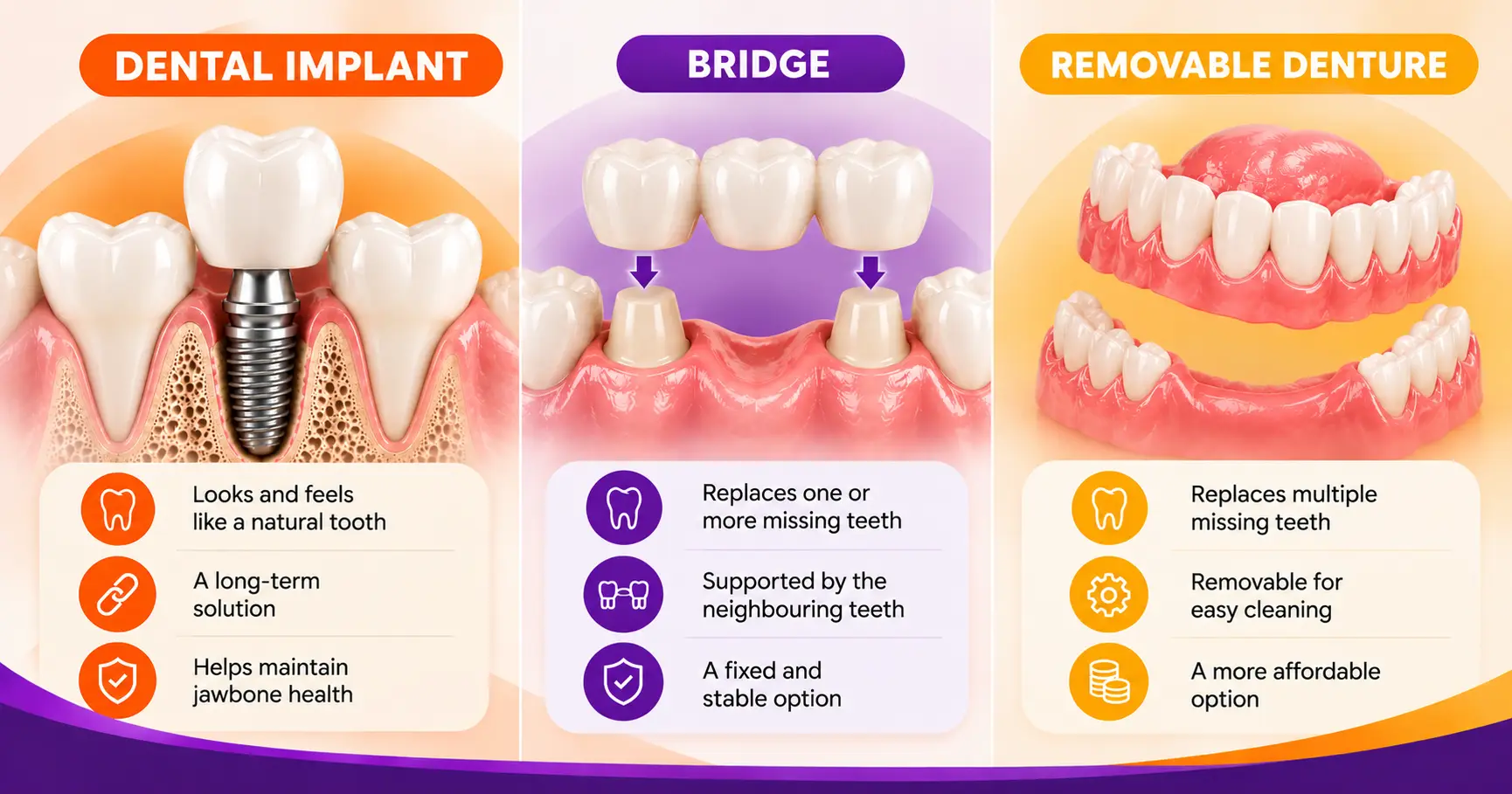 How does implant lifespan compare to dentures and bridges?