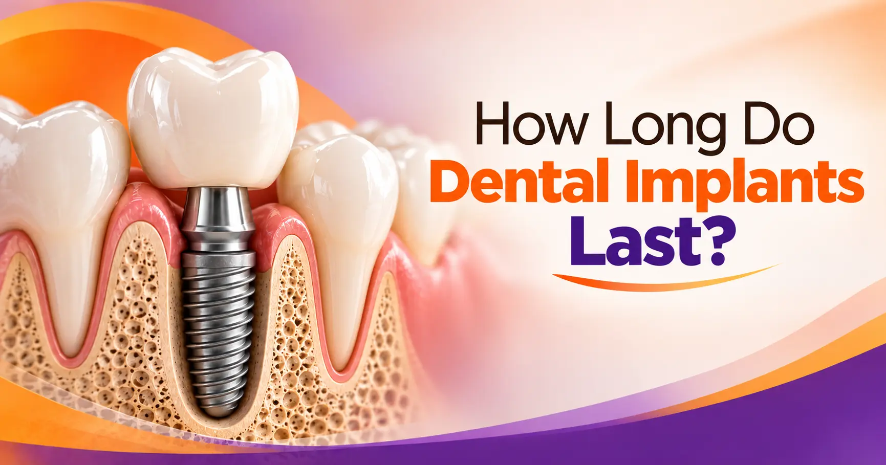 How Long Do Dental Implants Last?