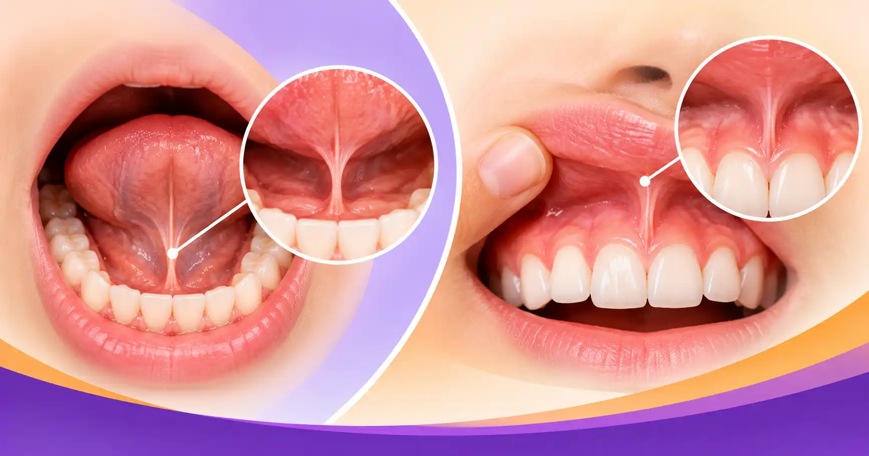 Understanding Tongue-Tie & Lip-Tie: Symptoms, Causes, and Modern Laser Frenectomy in Sydney